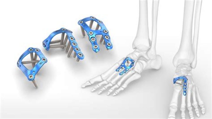 What is a surgical arthrodesis?