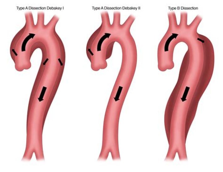 What is a type 3 aortic dissection?