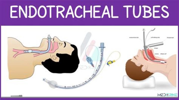 What is an acceptable reintubation rate?