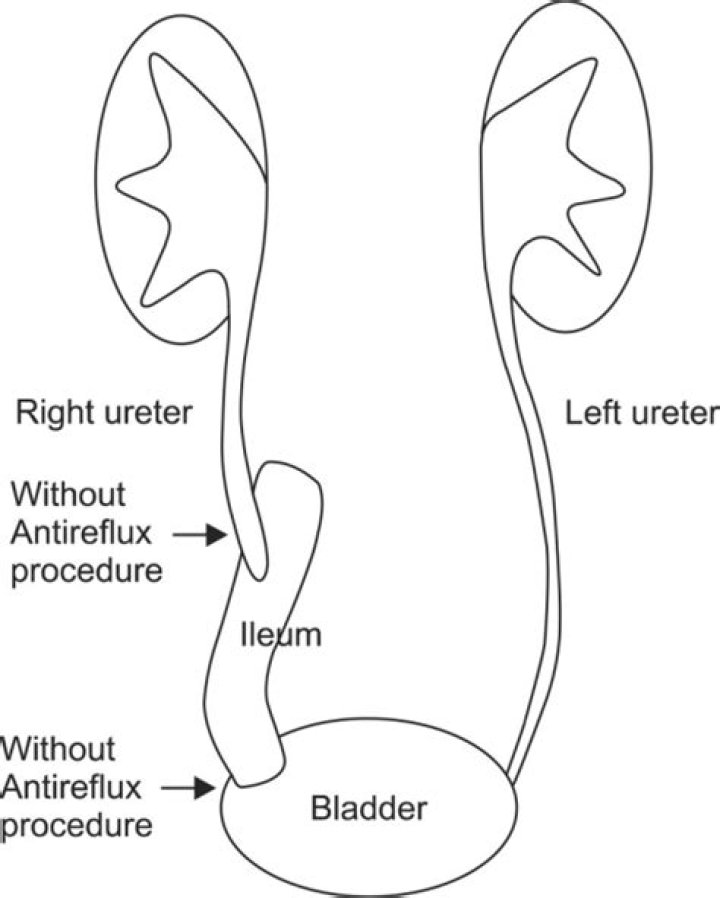What is an ileal ureter?