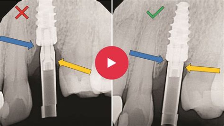 What is Ankylos implant?