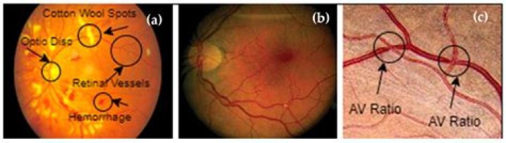 What is AV ratio retina?