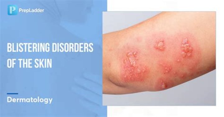 What is bullous dermatitis herpetiformis?