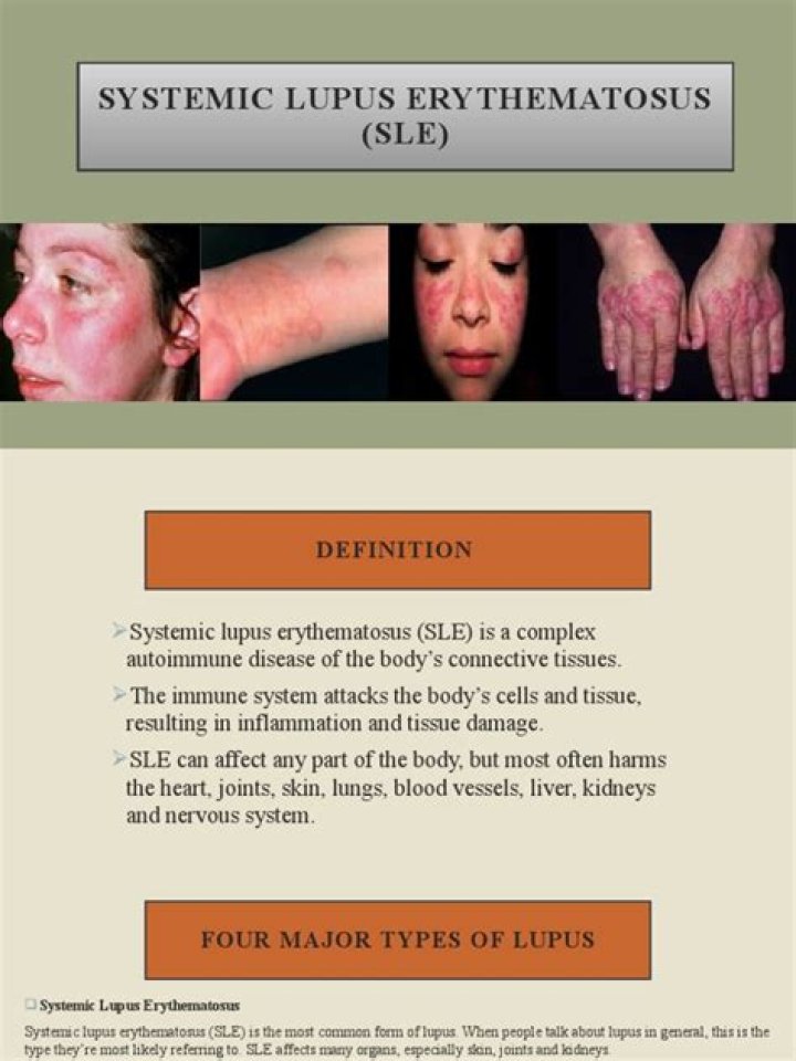 What is bullous lupus erythematosus?