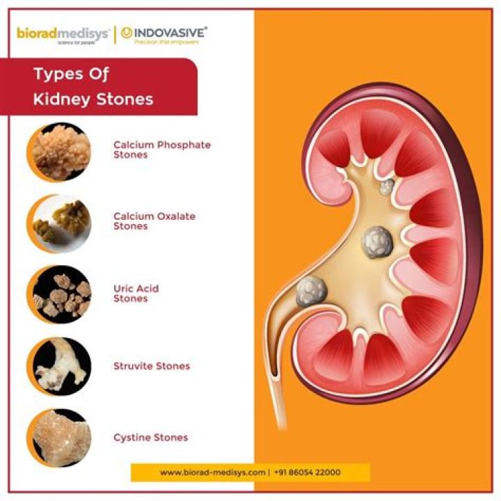 What is carbonate apatite kidney stone?