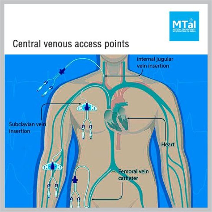 What is central venous catheter infection?