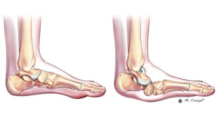 What is Charcot known for?