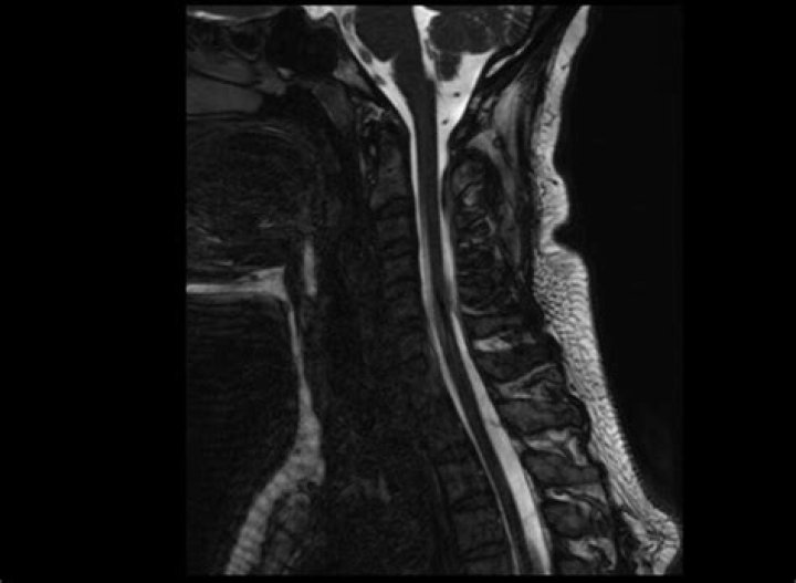 What is CISS sequence in MRI?