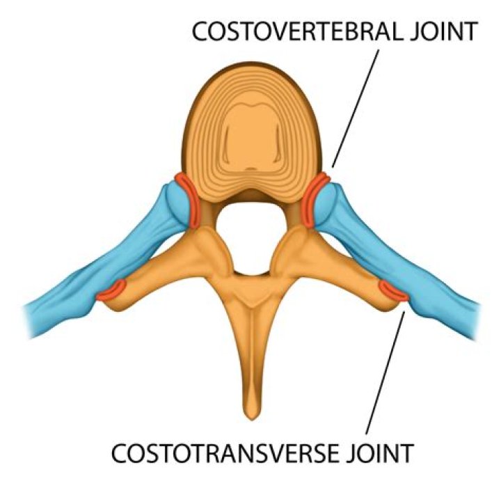 What is Costovertebral osteoarthritis?