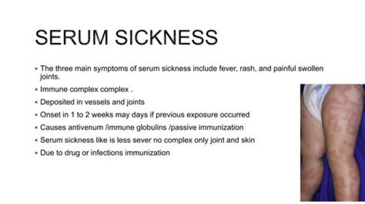 What is drug serum sickness?