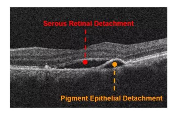 What is Drusenoid pigment epithelium detachment?
