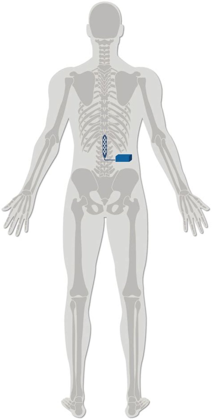 What is epidural stimulation for spinal cord injury?