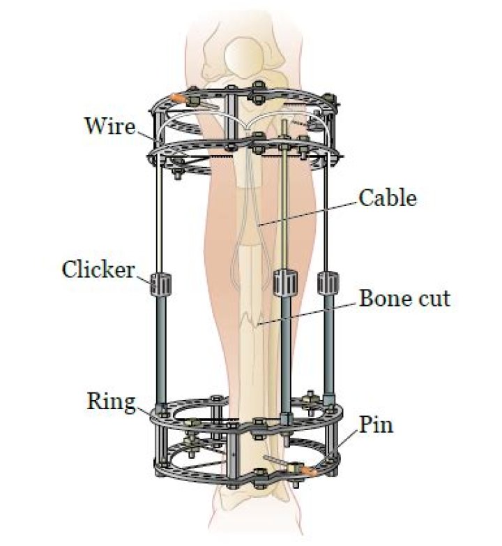 What is external fixation of a fracture?