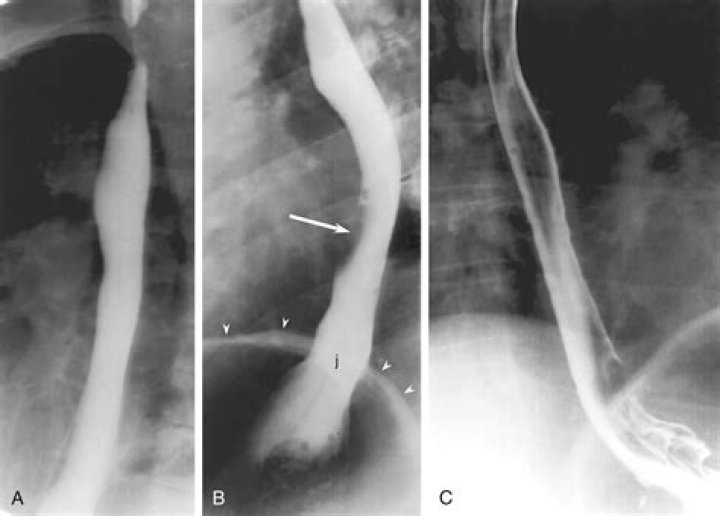 What is fluoroscopic examination of the esophagus?