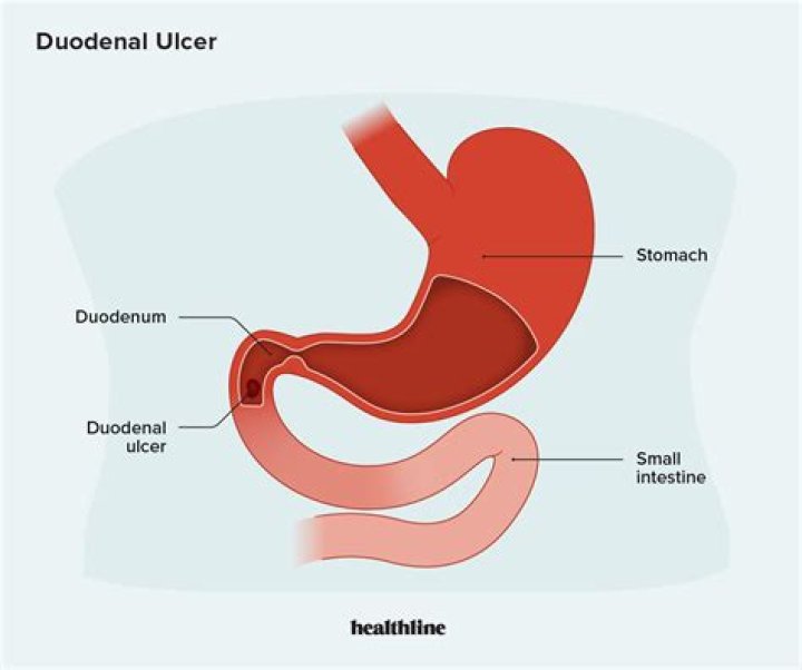 What is gastric heterotopia duodenum?