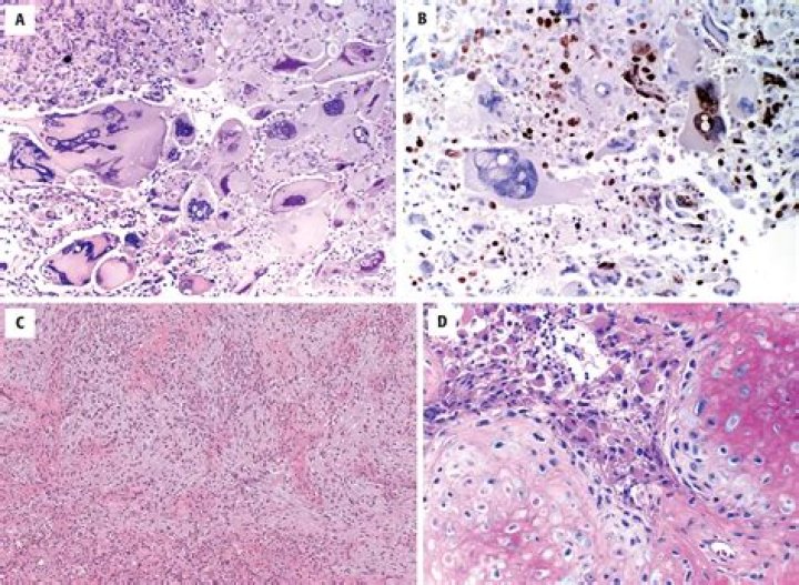 What is gemistocytic?