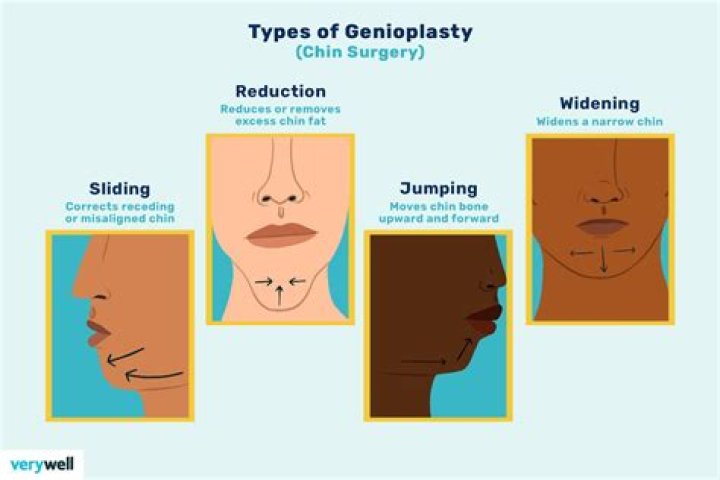 What is genioplasty surgery?