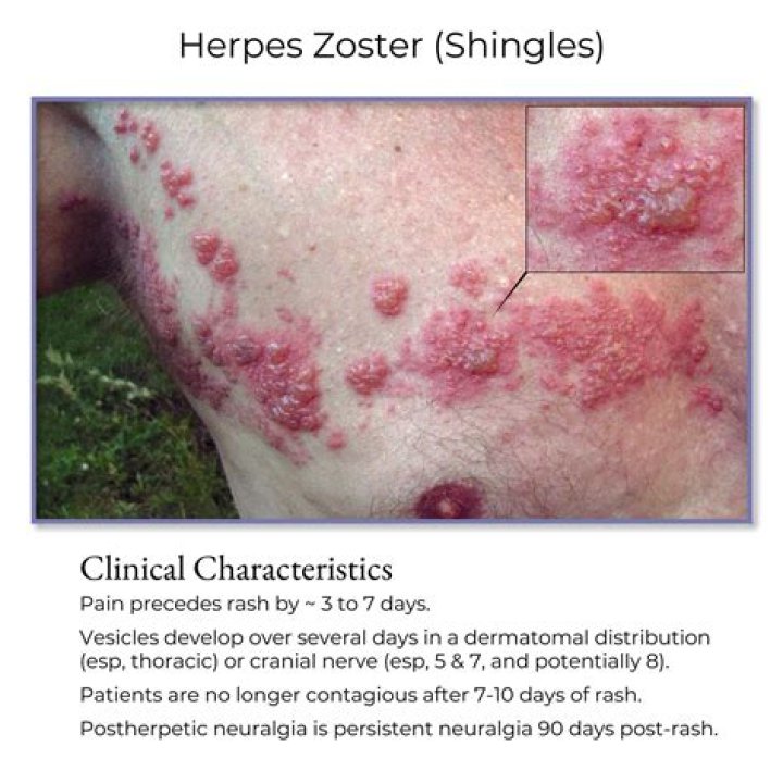 What is herpes zoster of the eye?
