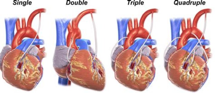 What is in a quadruple bypass burger vortex?