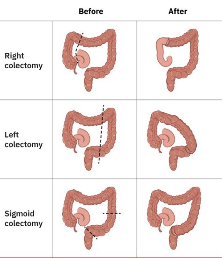What is included in a left hemicolectomy?