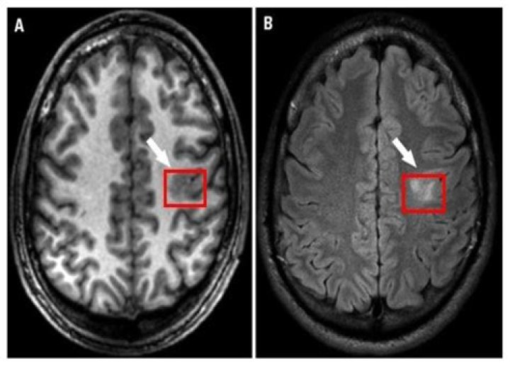 What is intralabyrinthine?