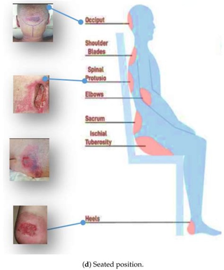 What is ischial wound?