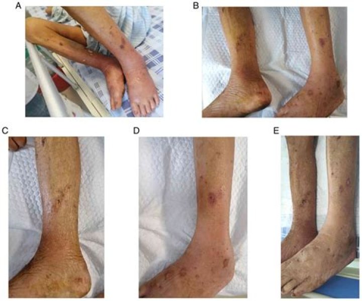 What is Klebsiella infection?