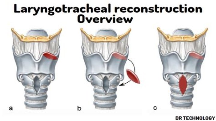 What is Laryngotracheal resection?