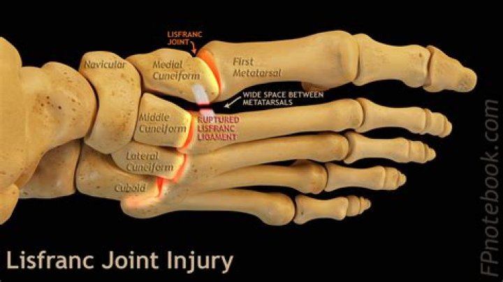 What is Lisfranc fracture dislocation?