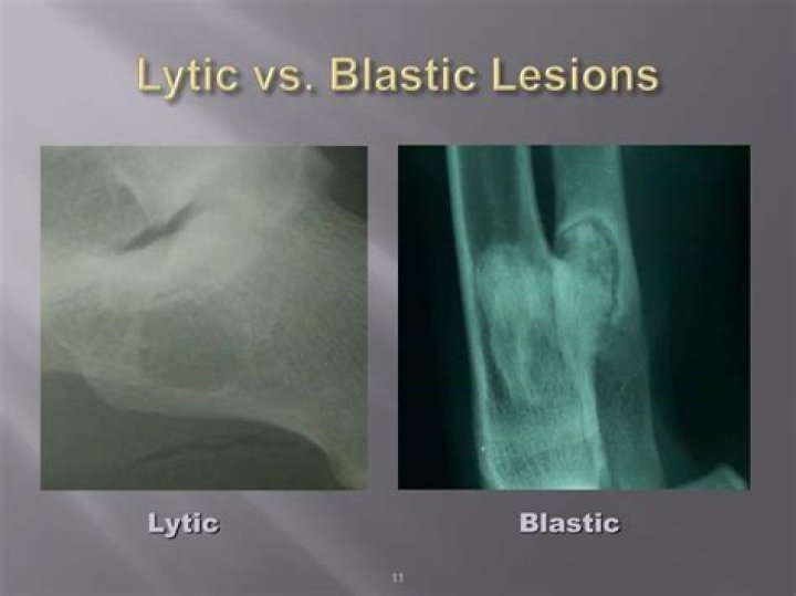 What is lytic or blastic lesions?