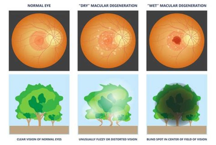 What is macular disruption?