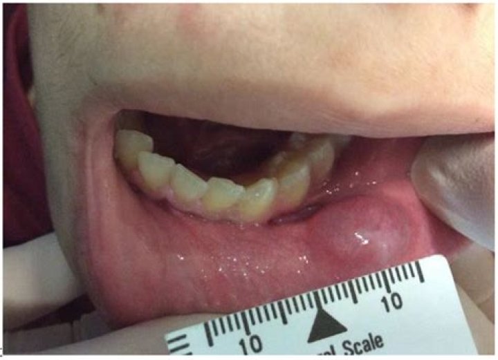 What is Marsupialization of ranula?
