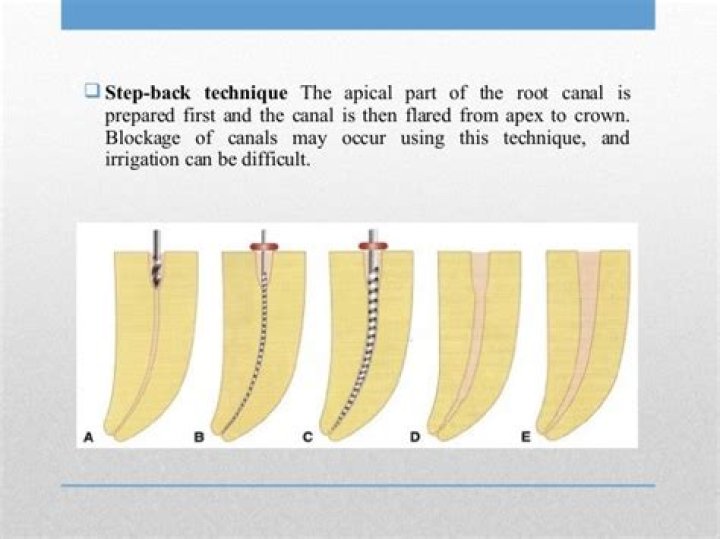 What is master apical file in endodontics?