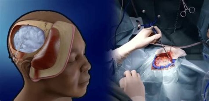 What is meningioma craniotomy?