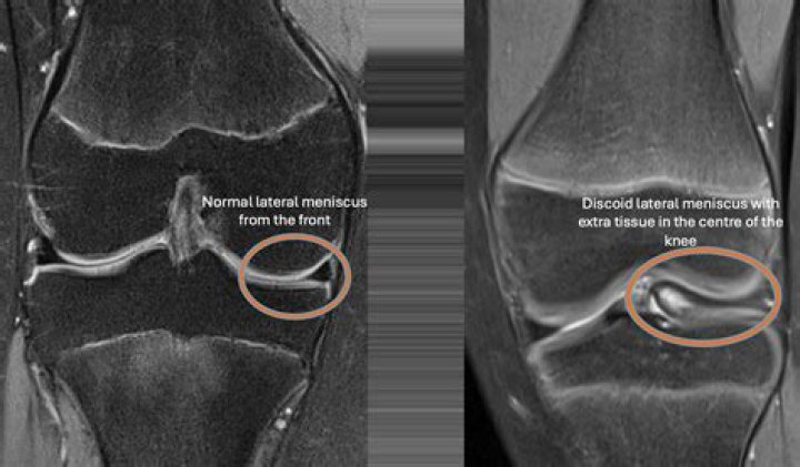 What is Meniscocapsular injury?