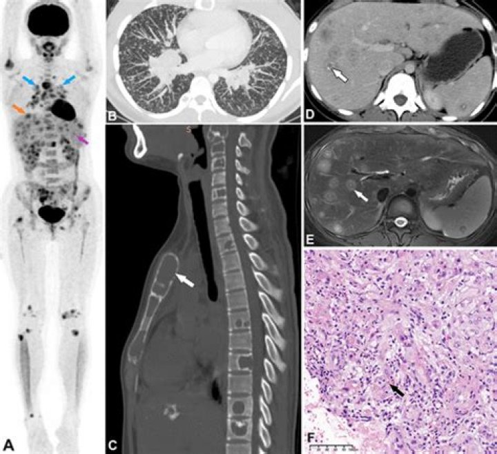 What is metastatic epithelioid hemangioendothelioma?
