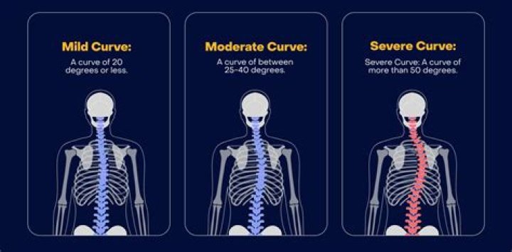 What is mild spinal curvature?