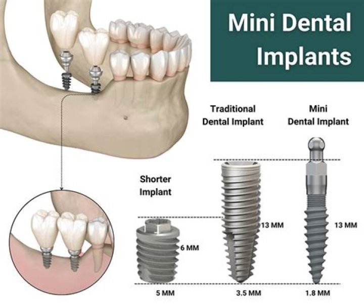 What is mini max procedure?