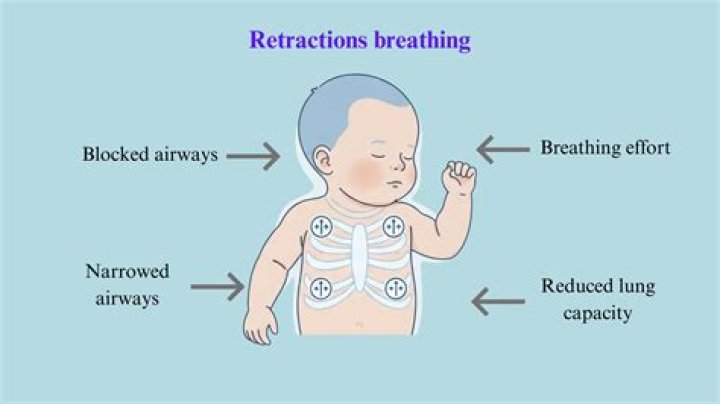 What is newborn chest retraction?