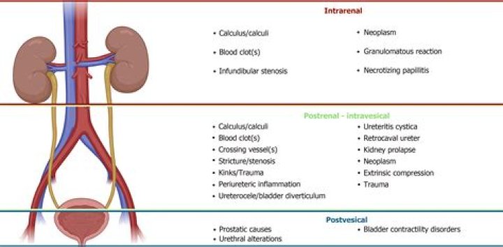 What is non obstructive left renal calculi?