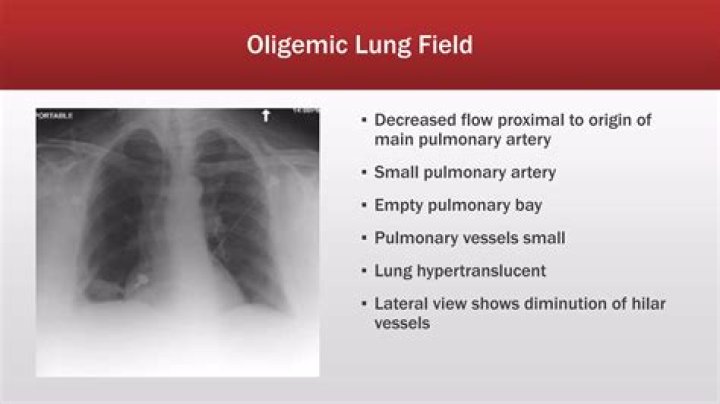 What is Oligemic lung field?