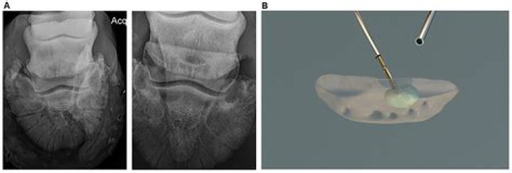 What is osteostixis?