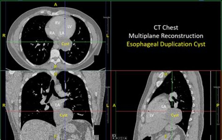 What is Pleuropericardial cyst?