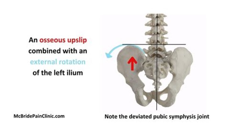 What is posterior innominate rotation?