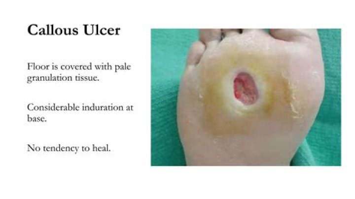What is pre ulcerative callus?