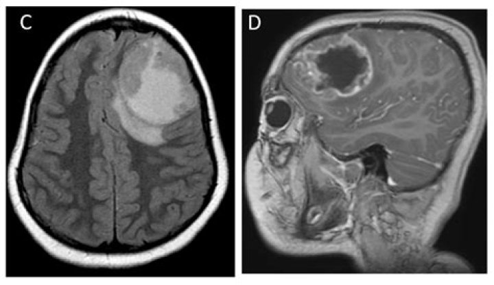 What is pseudo cerebral tumor?