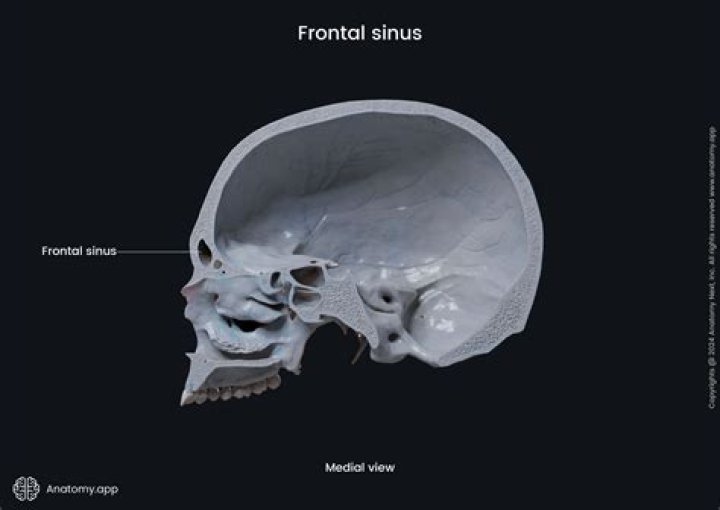 What is right frontal sinusitis?