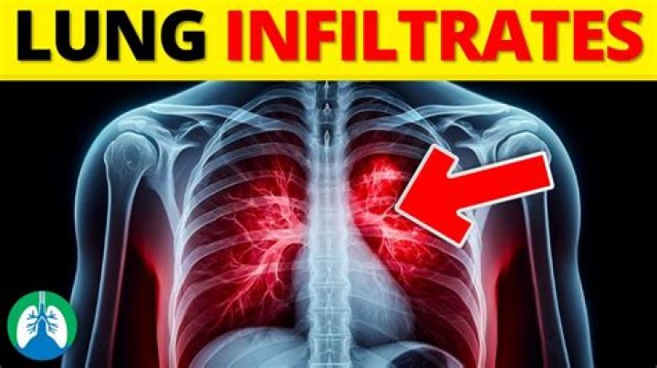 What is right lobe infiltrate?