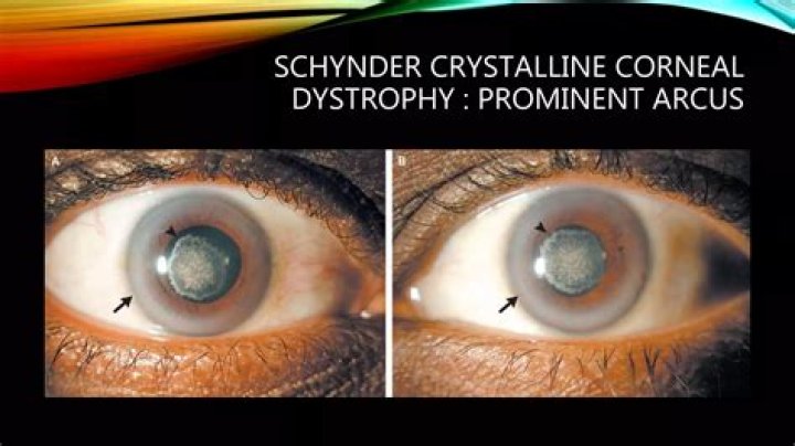 What is Schnyder central crystalline dystrophy?
