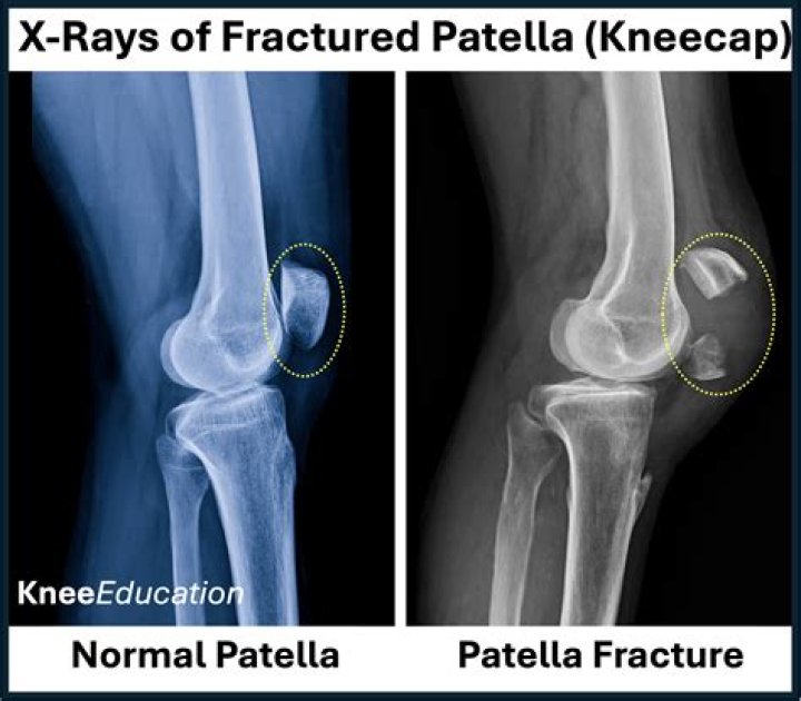 What is spontaneous patellar fracture?